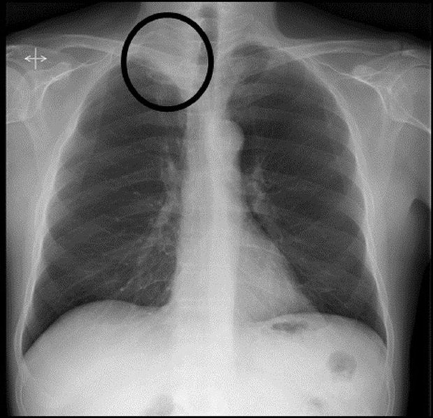 2 vị trí đau bất thường cảnh báo ung thư phổi nhưng dễ bị bỏ qua - Ảnh 2.