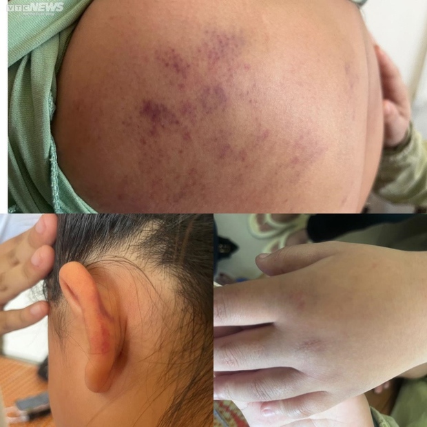 Bị lột đồ, đánh hội đồng 2 giờ: Nữ sinh Phú Yên đau đớn ra sao?