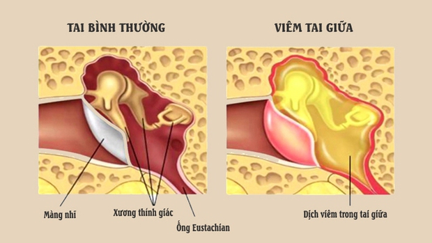 Bác sĩ kể trường hợp bé gái bị viêm tai giữa sau chuyến du lịch hè và lưu ý quan trọng cho phụ huynh - Ảnh 3.