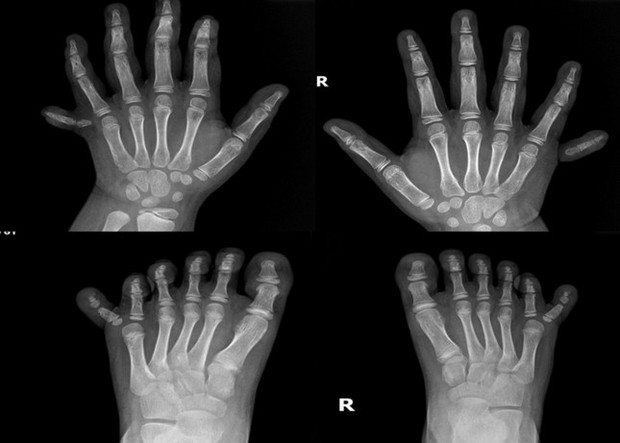 Em bé có 12 ngón tay, 12 ngón chân cực kỳ hiếm gặp - Ảnh 1.