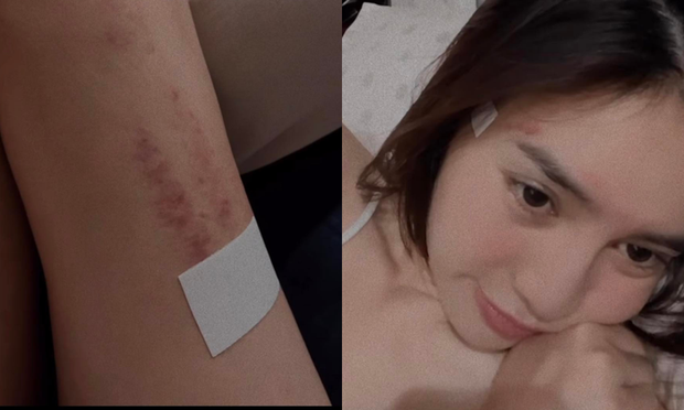 Ninh Dương Lan Ngọc đốn tim fan hâm mộ với vết bầm tím chân nghi vấn