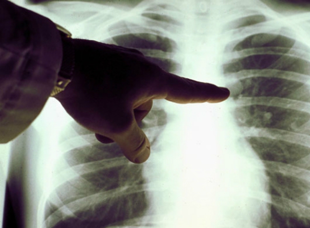 4 thủ phạm gây ra ung thư phổi: Số 1 nhiều người Việt vẫn đang duy trì - Ảnh 1.