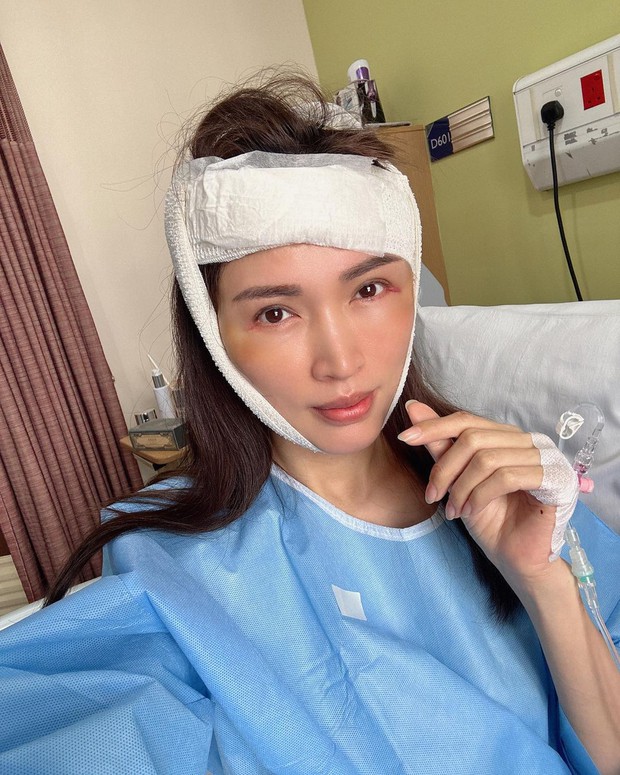 Mẫu người nổi tiếng ngã cầu thang, bất ngờ bị thương đến tận bước phẫu thuật