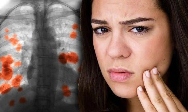 Dấu hiệu cảnh báo ung thư phổi từ khuôn mặt - Bí quyết phát hiện bệnh sớm hiệu quả