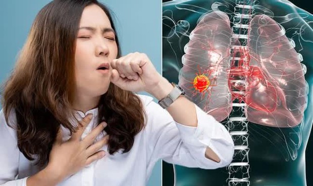 Dấu hiệu cảnh báo ung thư phổi từ khuôn mặt - Bí quyết phát hiện bệnh sớm hiệu quả