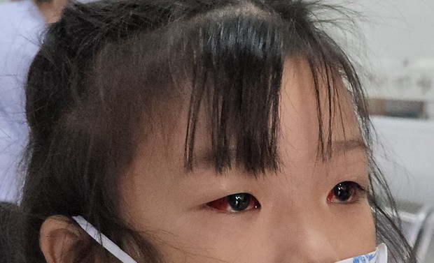 Cách phòng ngừa và điều trị hiệu quả đau mắt đỏ