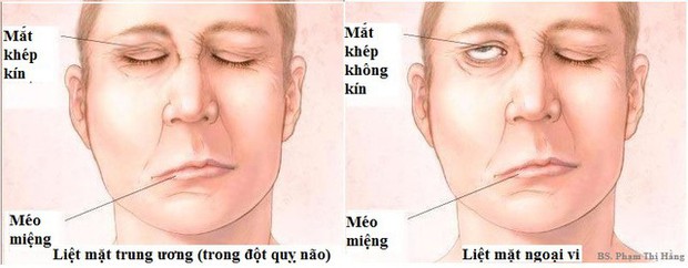 Trúng gió và đột quỵ não thường bị nhầm lẫn, phân biệt ra sao để có cách xử trí đúng? - Ảnh 2. Trúng gió và đột quỵ não thường bị nhầm lẫn, phân biệt ra sao để có cách xử trí đúng? - Ảnh 2.