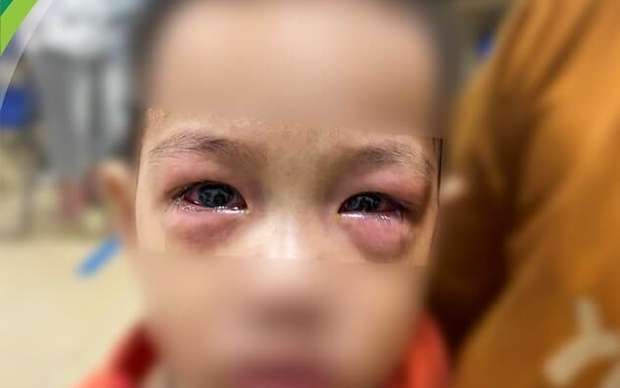 Bệnh đau mắt đỏ lây lan cả nước, bác sĩ đưa những cách hạn chế nhiễm bệnh trong giai đoạn này - Ảnh 2.