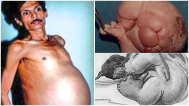 Người đàn ông mang trong mình thai chết lưu suốt 36 năm, bào thai nặng 4kg, có cả tóc và tay chân - Ảnh 1.
