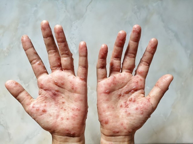 Việt Nam xuất hiện 2 ca đậu mùa khỉ chưa rõ nguồn lây, làm 6 điều để phòng bệnh - Ảnh 2. Việt Nam xuất hiện 2 ca đậu mùa khỉ chưa rõ nguồn lây, làm 6 điều để phòng bệnh - Ảnh 2.