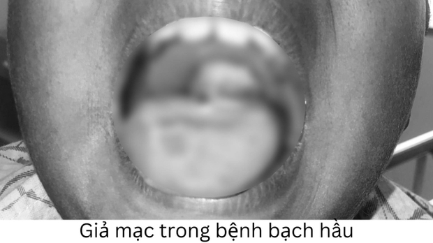 Bệnh bạch hầu trở lại: Làm thế nào để nhận biết và phòng tránh hiệu quả? - Ảnh 1.