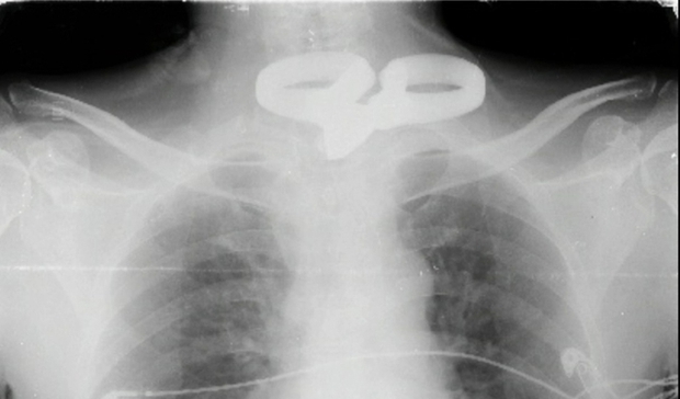 Người đàn ông mù 2 mắt tự lấy kéo đâm vào bụng và cổ - Ảnh 2.