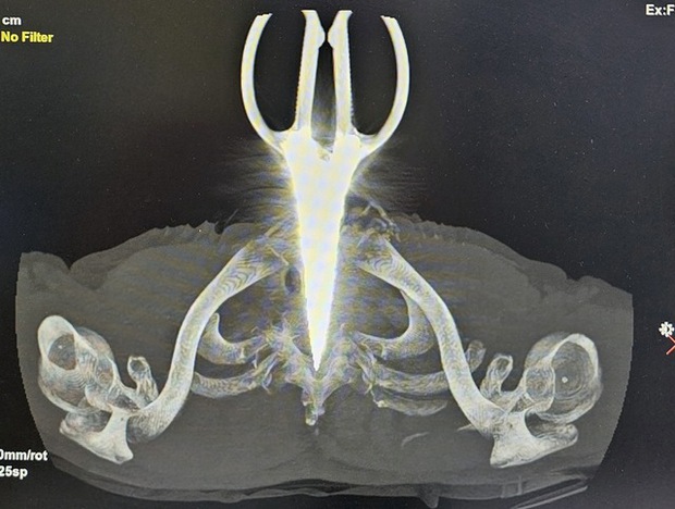 Người đàn ông mù 2 mắt tự lấy kéo đâm vào bụng và cổ - Ảnh 1.