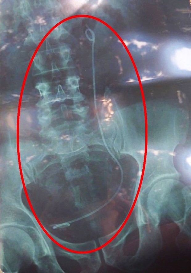 Lâm Đồng: Nhầm kết quả X-quang, bệnh nhân phải thực hiện nội soi tìm dị vật - Ảnh 2.
