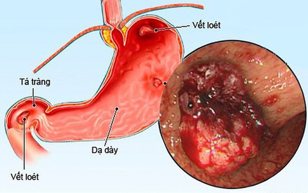 Cảnh giác với viêm loét dạ dày do vi khuẩn HP ở trẻ em - Ảnh 1.