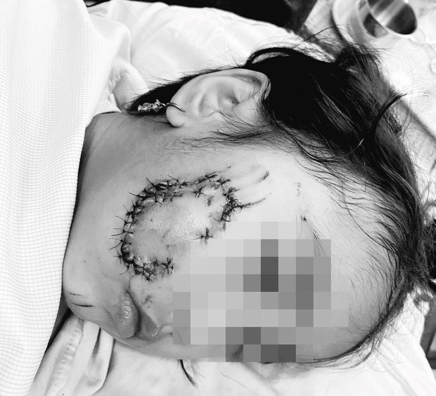 Cháu bé 5 tuổi bị chó cắn phải khâu gần 50 mũi - Ảnh 1.