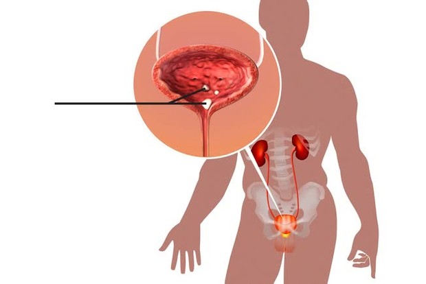 9 vị trí cơ thể có thể mọc sỏi và những triệu chứng nhận biết nhanh - Ảnh 3.