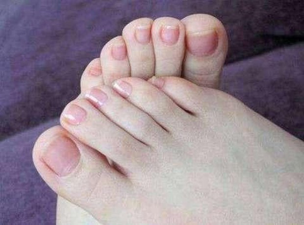 Phù nề trên bàn chân