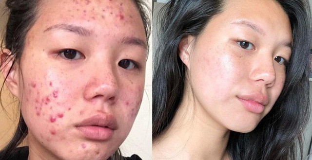 Dù bị mụn hay không, bạn cũng sẽ học được nhiều tips skincare từ cô nàng lột xác làn da 