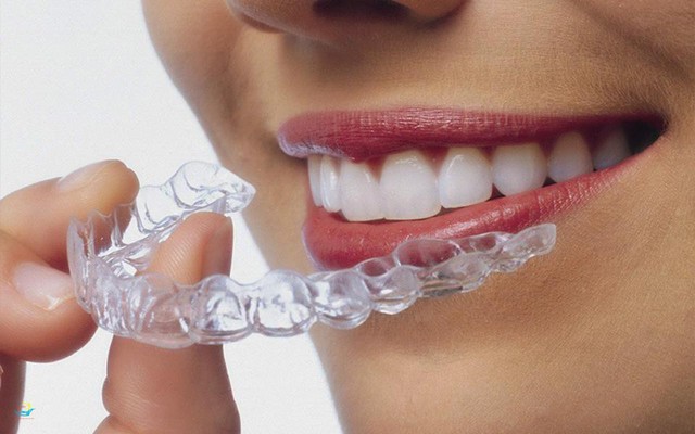 Niềng răng không mắc cài