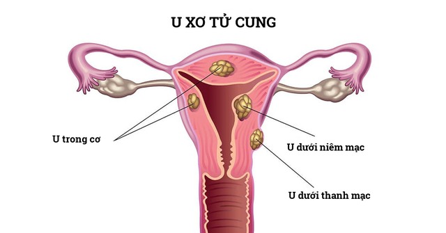 Cựu thành viên T-ara bất ngờ phát hiện khối u tử cung, liệu có nguy hiểm?- Ảnh 2.