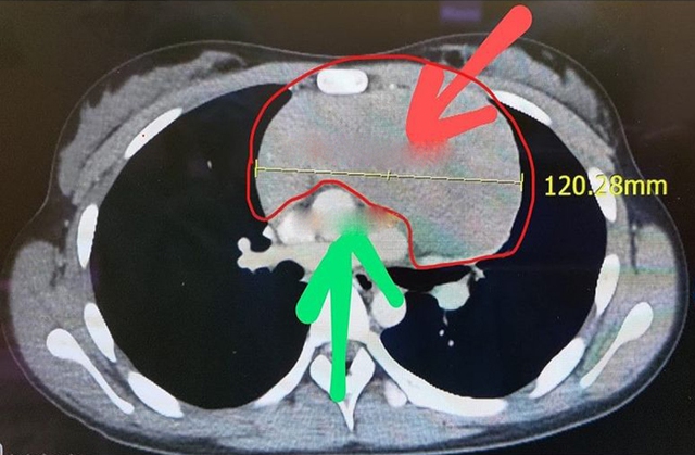 Bé gái 13 tuổi mang “quả bom hẹn giờ” 12cm trong ngực mà không hề hay biết- Ảnh 2.