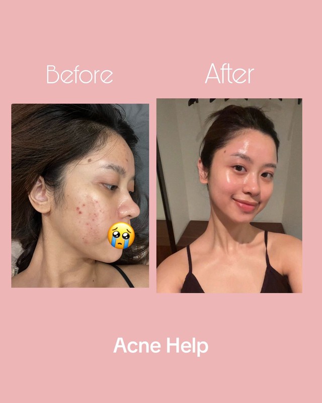 Routine chăm da mụn, da treatment cực chi tiết của Hàn Hằng: Kĩ thế này bảo sao visual cứ đỉnh mãi!- Ảnh 8.