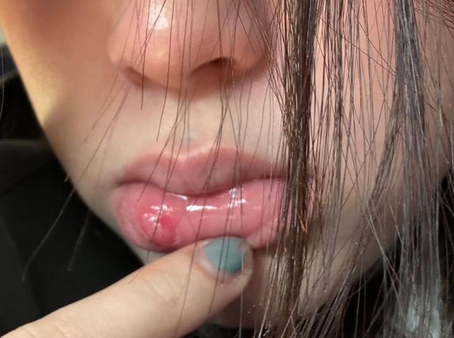 5 thay đổi ở môi đang CHỈ ĐIỂM ung thư dù nhiều người "không thèm để ý"- Ảnh 1.