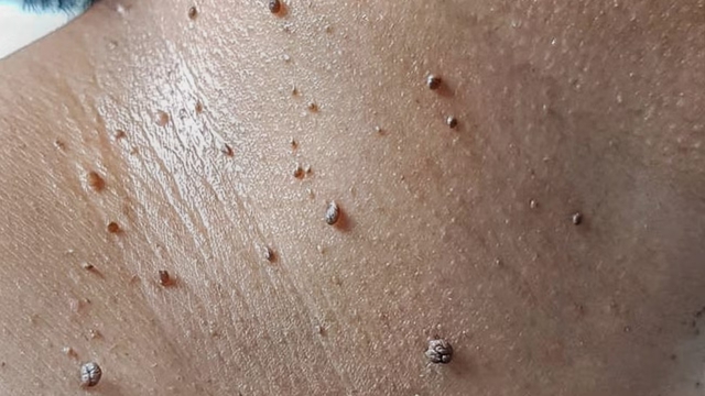 Người có 4 thứ này trên da dễ có "cả đống" tế bào ung thư trong người mà chưa biết- Ảnh 1.