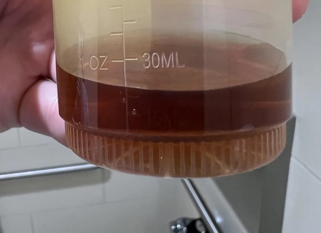 Sáng dậy nhận thấy 5 dấu hiệu này, chỉ sợ gan của bạn đã "xơ xác" như tổ ong!- Ảnh 2. Sáng dậy nhận thấy 5 dấu hiệu này, chỉ sợ gan của bạn đã "xơ xác" như tổ ong!- Ảnh 2.