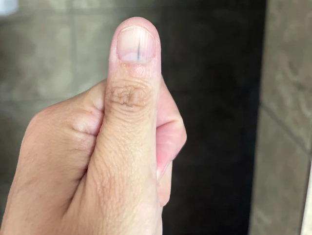 SOS với 5 dấu hiệu ung thư lộ rõ trên móng tay, nhiều người không hiểu vẫn "bình chân như vại"- Ảnh 1.