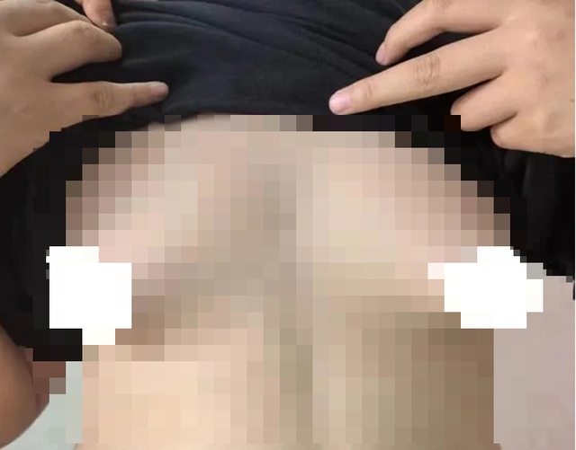 Nam sinh 14 tuổi phải phẫu thuật cắt bỏ "vòng 1" vì... quá to, bác sĩ tức giận: Ở nhà cho cháu ăn gì?- Ảnh 1.