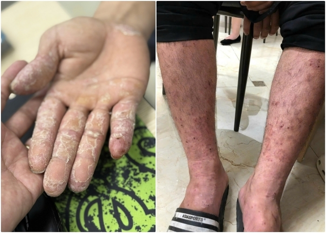 Những bệnh về da thường gặp sau mưa lũ