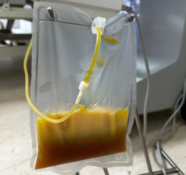 Người đàn ông 40 tuổi "máu ngập dầu" sau bữa tối, bác sĩ cấp cứu tức giận: Ăn thế này có ngày tử vong!- Ảnh 1.