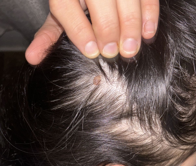 Chải đầu mà thấy 3 bất thường này phải cảnh giác với ung thư: Tiếc là ít người để tâm!- Ảnh 2. Chải đầu mà thấy 3 bất thường này phải cảnh giác với ung thư: Tiếc là ít người để tâm!- Ảnh 2.