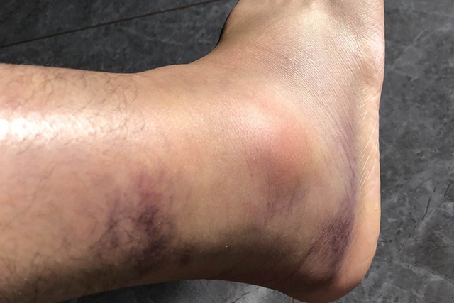 Người đàn ông phát hiện suy thận nhờ đi khám phù chân, bác sĩ sửng sốt: "Ai lại nêm gia vị như thế này?"- Ảnh 3.