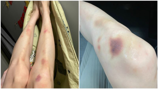 Một bất thường trên da đang cố TỐ CÁO ung thư máu nhưng lại bị đổ cho "đi đứng vụng về"- Ảnh 1.