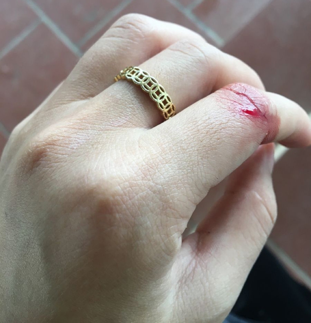 6 bất thường ở bàn tay đang ám chỉ lượng đường trong máu vượt ngưỡng an toàn, tiếc là rất ít người để ý!- Ảnh 2.