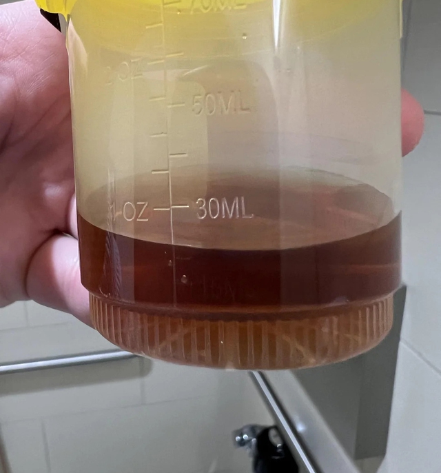 Cảnh b&aacute;o: Bất kể nam hay nữ, nếu 3 thứ n&agrave;y tr&ecirc;n người ng&agrave;y c&agrave;ng &ldquo;đen&rdquo; chứng tỏ thận chất đầy độc tố- Ảnh 3.