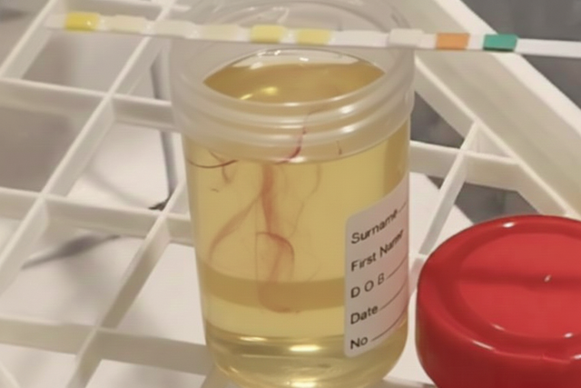 Tiến sĩ Anh cảnh báo: Ung thư thận rất giỏi "lẩn trốn" và đây là 3 dấu hiệu giúp bạn "tóm" bệnh sớm- Ảnh 1. Tiến sĩ Anh cảnh báo: Ung thư thận rất giỏi "lẩn trốn" và đây là 3 dấu hiệu giúp bạn "tóm" bệnh sớm- Ảnh 1.