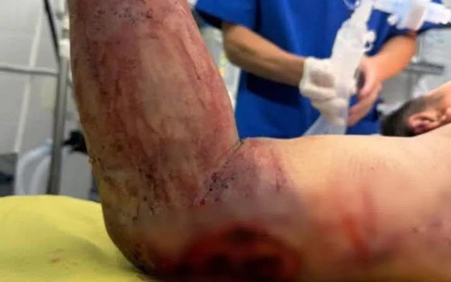 Tai nạn nổ bình gas, cảnh báo an toàn lao động tại nhà- Ảnh 1. Tai nạn nổ bình gas, cảnh báo an toàn lao động tại nhà- Ảnh 1.