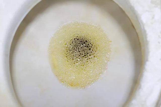 Tại sao ung thư thận thường phát hiện muộn? Đã có quá nhiều người bỏ lỡ "2 nhiều, 1 ít" này ở giai đoạn sớm!- Ảnh 2. Tại sao ung thư thận thường phát hiện muộn? Đã có quá nhiều người bỏ lỡ "2 nhiều, 1 ít" này ở giai đoạn sớm!- Ảnh 2.