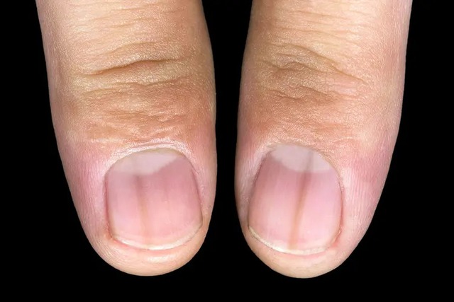 7 vị trí trên cơ thể thường chuyển sang MÀU ĐEN khi ung thư xuất hiện, tự kiểm tra ngay!- Ảnh 2. 7 vị trí trên cơ thể thường chuyển sang MÀU ĐEN khi ung thư xuất hiện, tự kiểm tra ngay!- Ảnh 2.