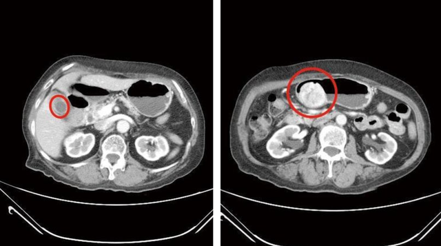 Khám tiêu chảy, người phụ nữ ngỡ ngàng phát hiện 1 túi đầy sỏi và khối u 6cm trong bụng- Ảnh 1.