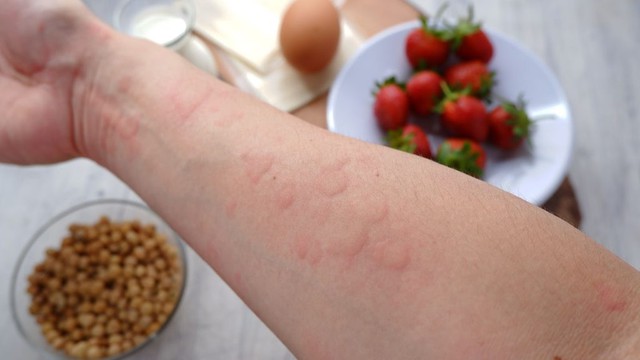 Người bị dị ứng trứng có tiêm được vắc xin sởi hay không?- Ảnh 1.