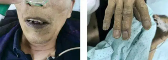 Nam thanh niên 25 tuổi tiểu ra "nước xanh kỳ quái”, hôn mê sâu vì trúng kịch độc thường thấy trong món ăn nhiều người Việt mê- Ảnh 2.