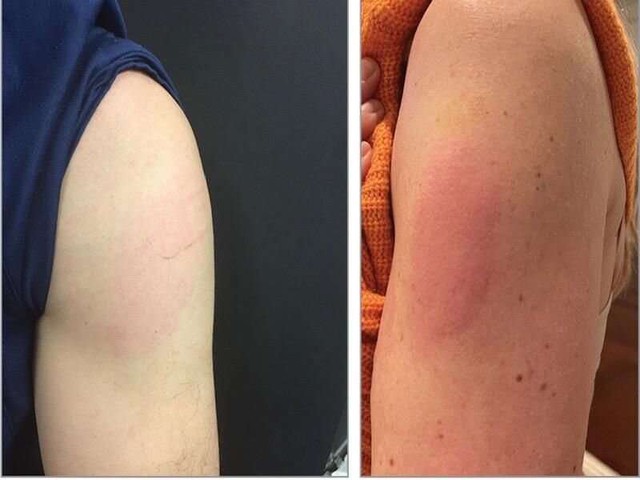 Tiêm vắc xin HPV có phản ứng phụ nào không, khi nào cần gặp bác sĩ?- Ảnh 1.