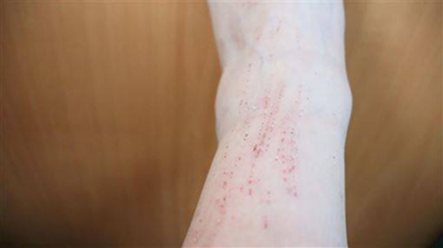 Ăn đồ luộc trong 20 năm, người phụ nữ bị loét da- Ảnh 1.