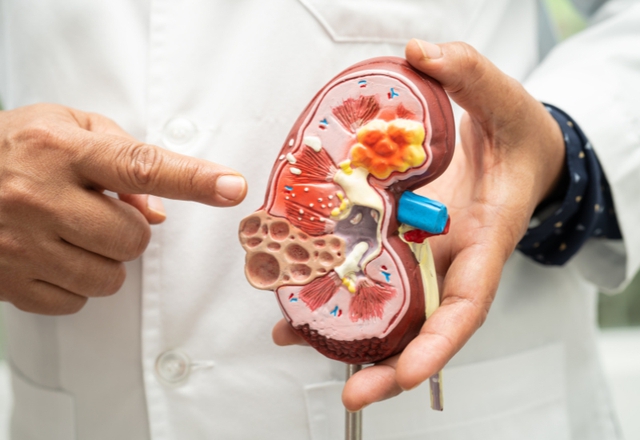 “Suy thận” trở thành từ khóa nóng sau trường hợp nữ diễn viên Ngân Hòa: Căn bệnh đang trẻ hóa đáng báo động- Ảnh 2.