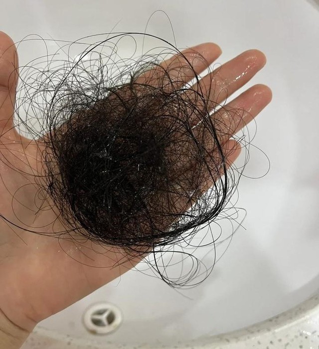 Đột nhiên tóc rụng từng mảng tới "hói trắng cả đầu", nữ sinh bàng hoàng khi nghe bác sĩ tiết lộ nguyên nhân- Ảnh 2.